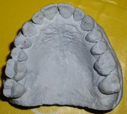 maxillary arch after